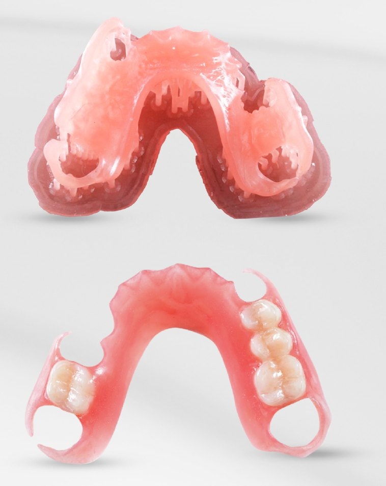 Próteses parciais removíveis flexíveis impressas com a resina Bio Adapt Flex